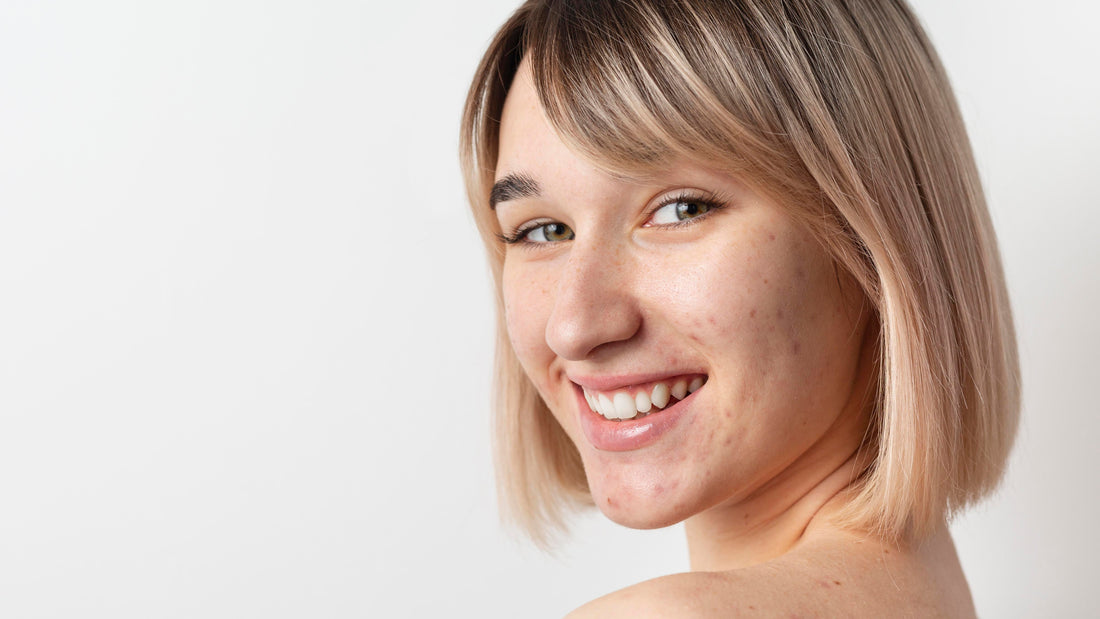 Achieve Clear, Balanced Skin: The Somoue Acne Set Explained